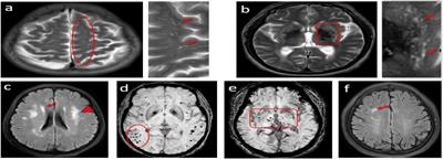 Cingulate sulcus sign: a descriptive analysis in a cerebral small vessel disease population